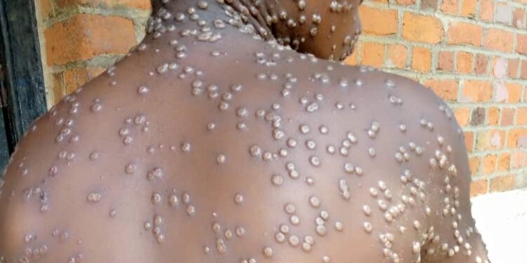 Mpox en Guinée : le Dr Ben Youssouf Keita brise le silence sur cette maladie virale qui inquiète